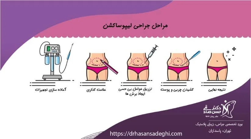 روند جراحی پیکرتراشی و لیپوساکشن