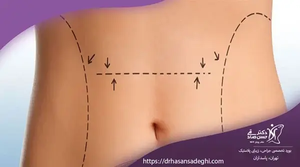 عمل-جراحی-شکم-برای-لاغری